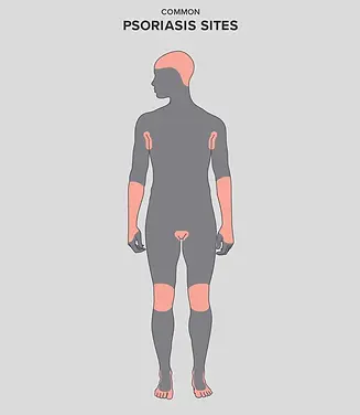 78892-common-psoriasis-sites-english-1296x2880-body.webp