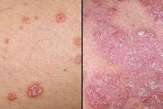 type of psoriasis 