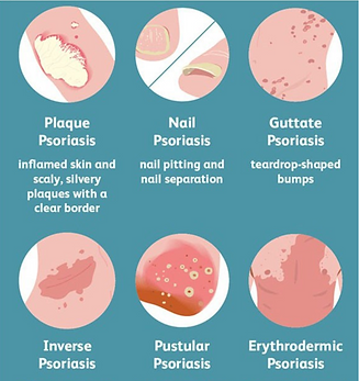 Symptoms of psoriases