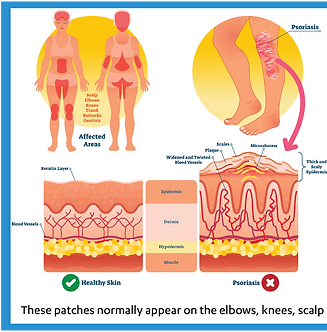diagram of explaining psoriasis