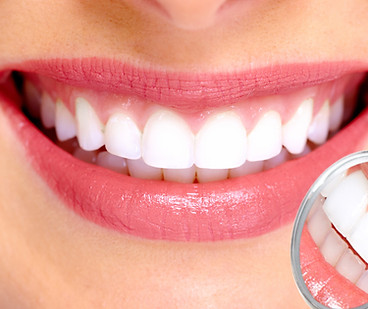 Perfect Smile