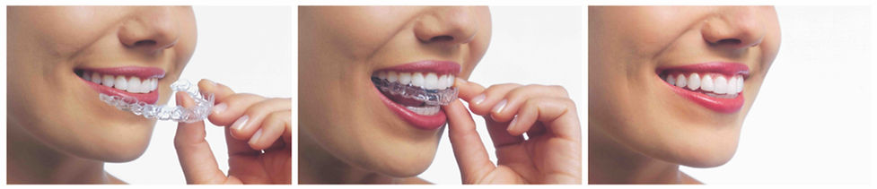 Terapia Invisalign