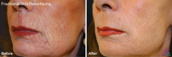 DermaBlate-BA_fractional-skin-resurfacin
