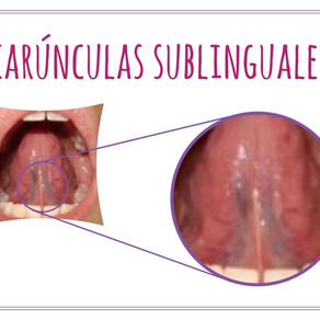 HABLEMOS SOBRE EL FRENILLO LINGUAL