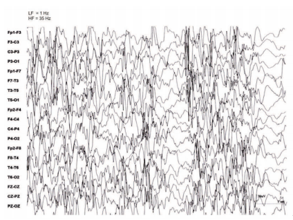 Traçado do eletroencefalograma demonstrando hipsarritmia, com ondas desorganizadas com espículas de alta voltagem. Fonte: Tratado de Neurologia Pediátrica.