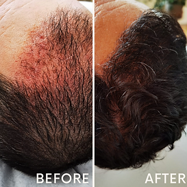 hair prp man biotin