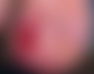 Мой подход к решению проблемы, "Вросший ноготь" или "Травма бокового валика в результате деформации ногтевой пластины".