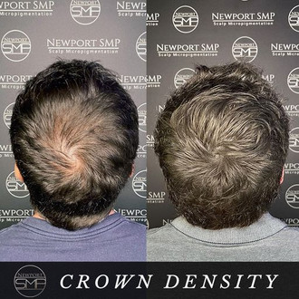 Crown Density Treatment SMP