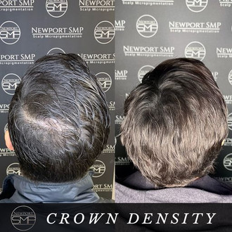 Crown Density Treatment SMP