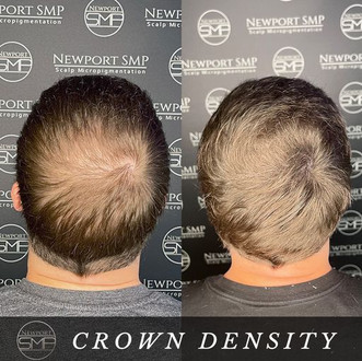 Crown Density Treatment SMP