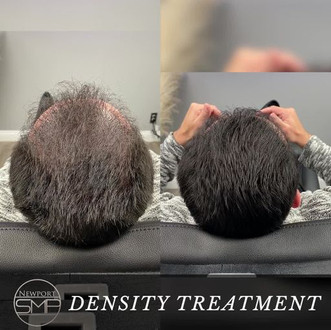 Density Treatment SMP