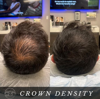 Crown Density Treatment SMP