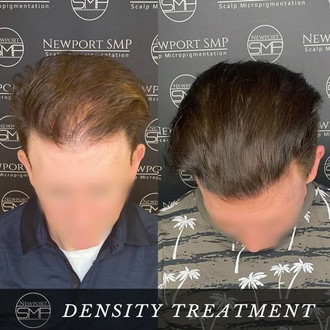 Density Treatment SMP
