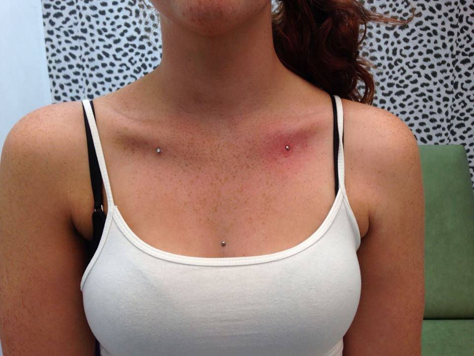 Mircrodermal triple
