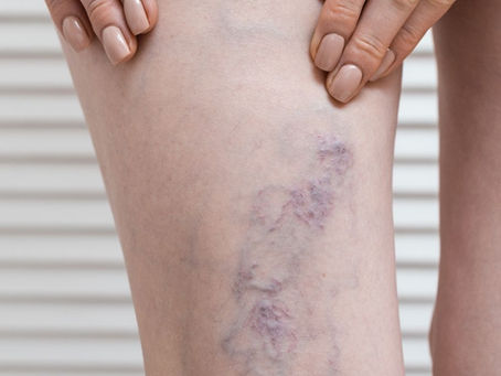 TRATAMENTO DE VARIZES