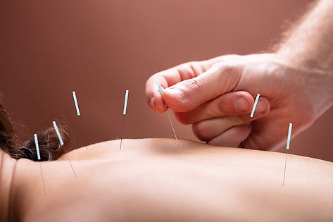 Accupuncture.jpg