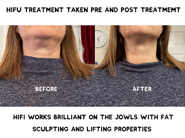 HIFU Cool, pre and post treatment, results, chin, neck, jowls, jawline, fat sculpting, lifting, skin tightening