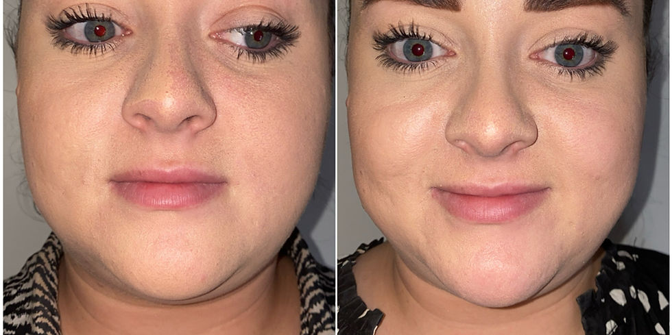 Fat-dissolving-chin.jpeg