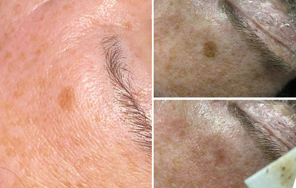 Plasma-dark-spot-removal-1w.jpg