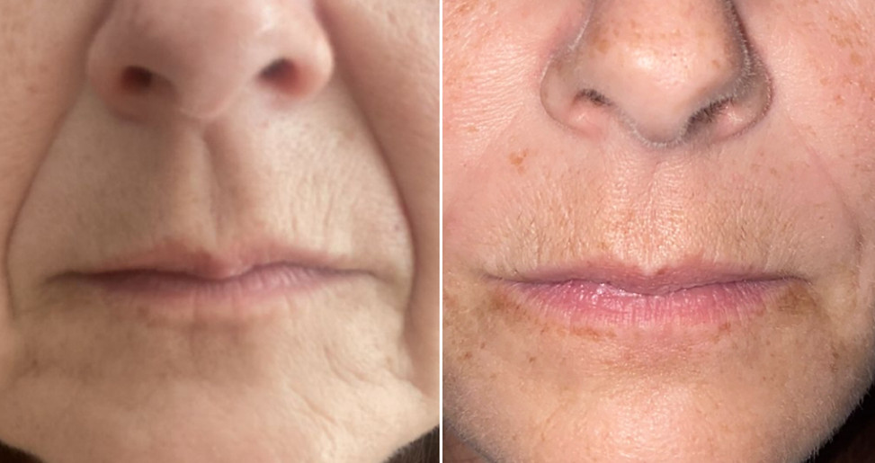 Nose to mouth lines 2-1.jpg