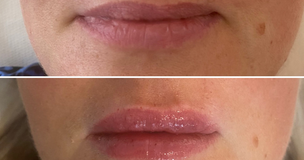 Uneven-lip-scarring-improved-with-filler.jpg