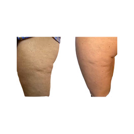 skin tightening RF Microneedling Balanced Soul Wellness in Jacksonville, Florida