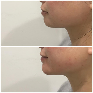 Chin5.jpeg