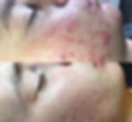 AZ Skin Therapy Acne Program Before and After 2