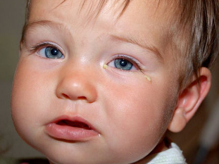 Infecciones de los ojos