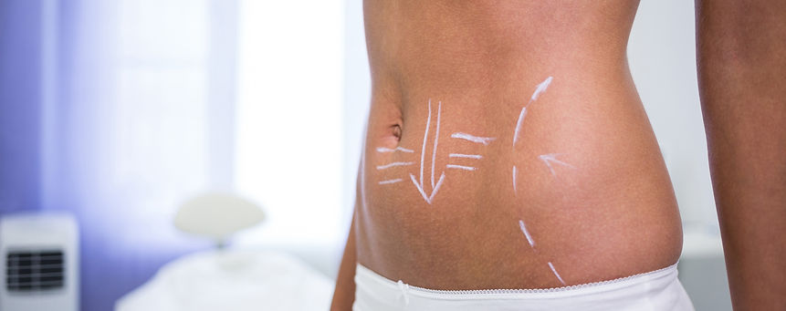 female-body-with-drawing-arrows-abdomen-liposuction-cellulite-removal.jpg
