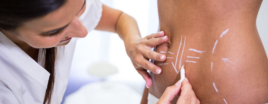 surgeon-drawing-lines-womans-abdomen-liposuction-cellulite-removal.jpg