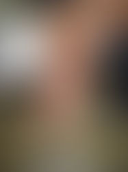 عمليه البتر