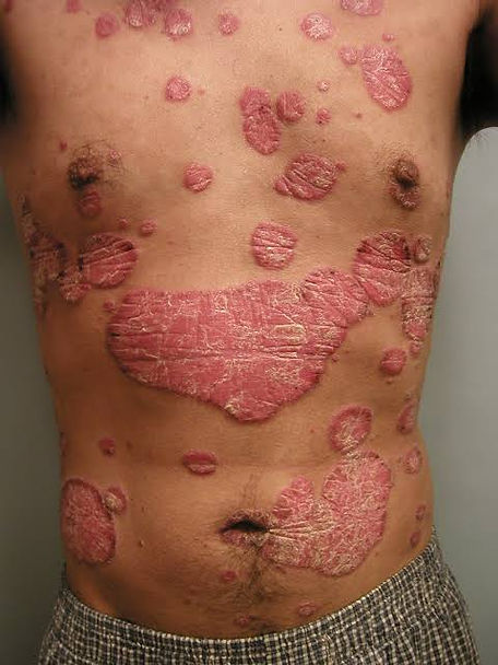 Psoriasis.JPG