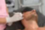 mens laser hair removal.jpeg