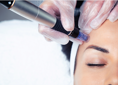 Microneedling