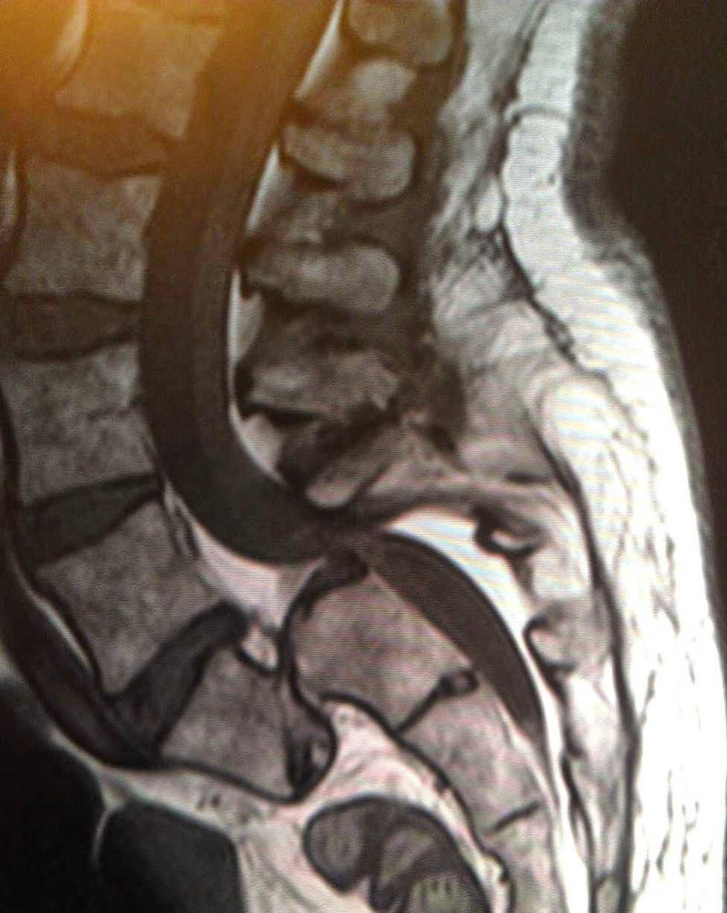 MRI Of Bulging Disc Lower Lumbar