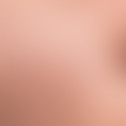 3 ways to get rid of blackheads
