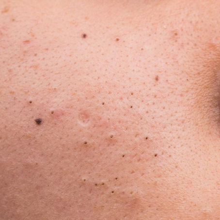 3 ways to get rid of blackheads
