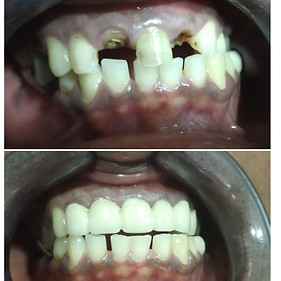 restored%20front%20teeth%20with%20caps_e