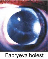 Ključna uloga oftalmologa u otkrivanju Fabryeve bolesti