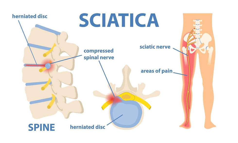 Sciatica: Why Treating the Pain Isn't Enough