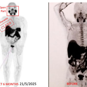 Europe, 74 Years old, Male, Use ECCT as an Alternative Cancer Treatment for Stage 4 Prostate Cancer