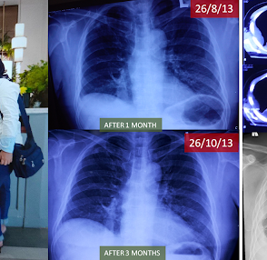 Choosing A Grave or Try Alternative Treatment for Lung Cancer: My Choice Won Me Another 10-Years of Life and Still Counting.选择坟墓还是尝试替代治疗以战胜肺癌：我的选择为我赢得了另外10年的生命，而且还在继续计数。