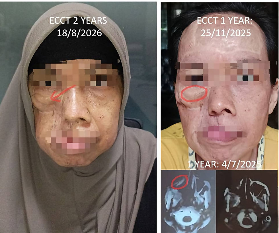 Rare Adenoid Cystic Carcinoma Cancer
