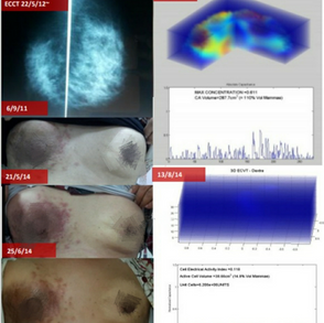 ECCT as the Treatment for breast Cancer with enlargement of the right axillary lymph nodes ECCT作为治疗右腋窝淋巴结肿大的乳腺的方法