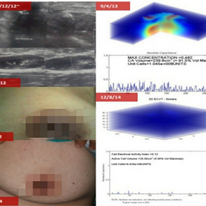 Alternative Treatment for Diffuse solid-cystic in left breast with left axillary lymphadenopathy. 左乳腺弥漫性实性囊性病变伴左腋淋巴结肿大的替代治疗