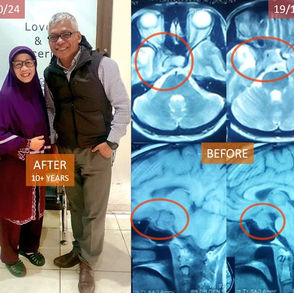 Overcoming Adversity: Journey with Recurrent Brain Tumor 克服逆境：与复发性脑肿瘤的抗争之旅