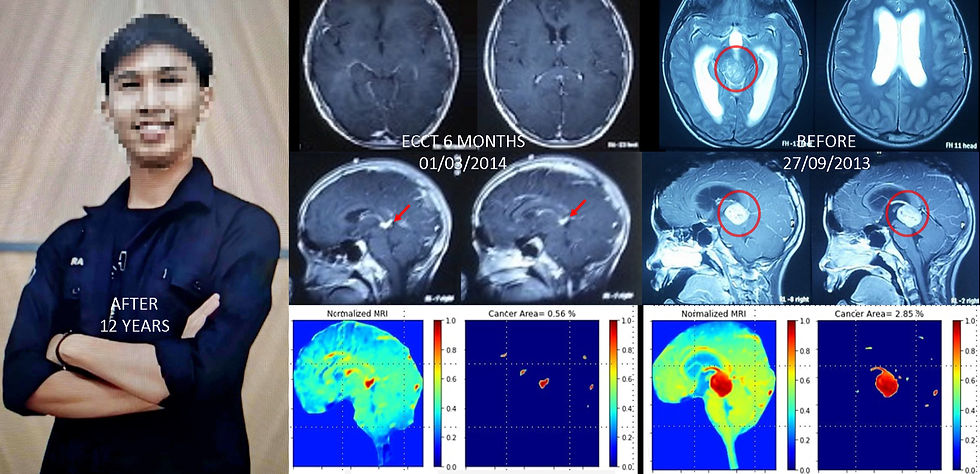 Brain Cancer in the Pineal Gland