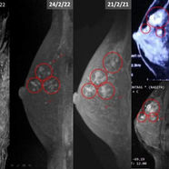 Japan: Survived 10 years from breast cancer without surgery and chemotherapy