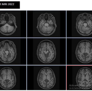 A Journey with Alternative Treatment for Pilocytic Astrocytoma Brain Cancer 